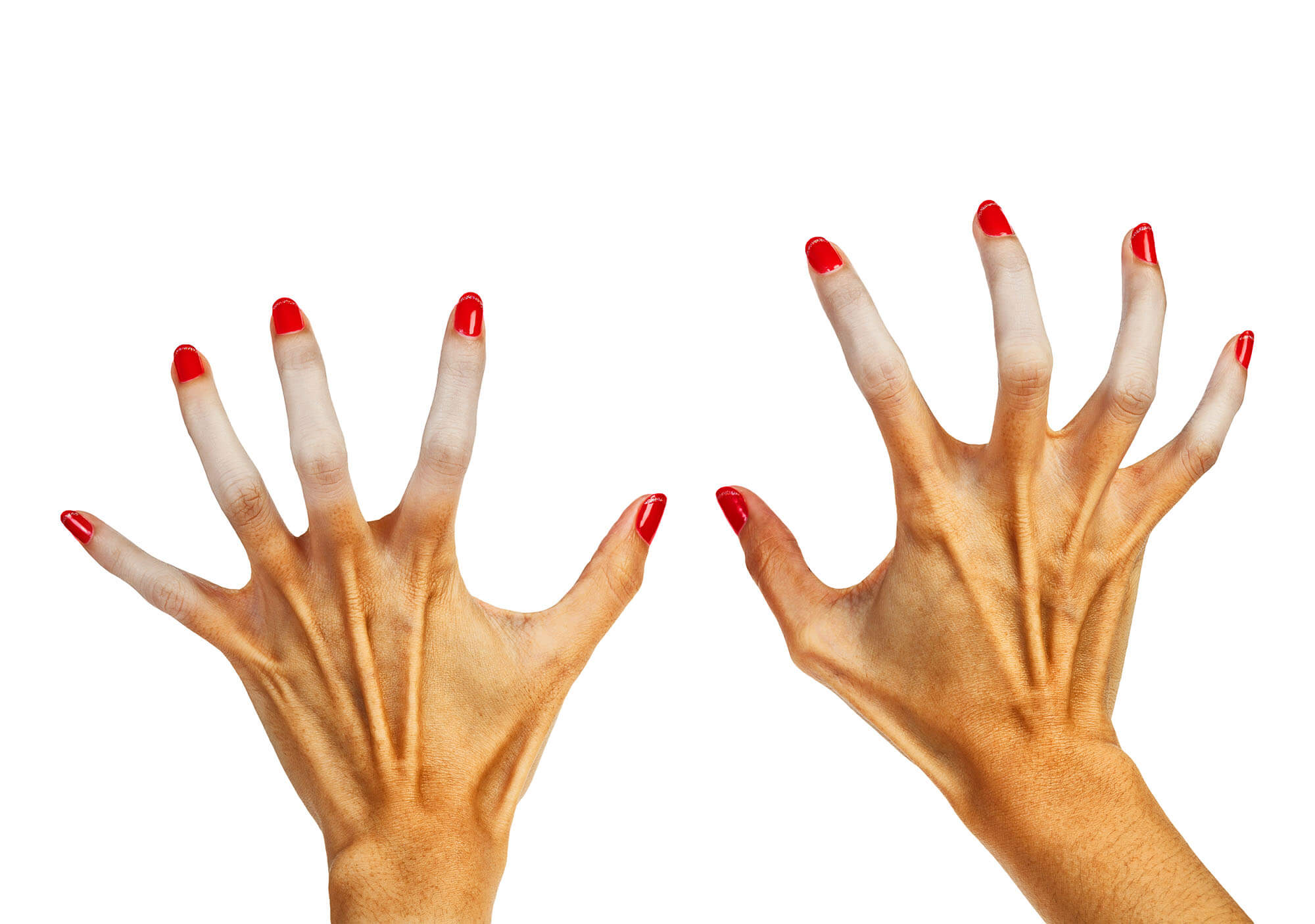 Se libérer du syndrome de Raynaud grâce à Pavlov ?